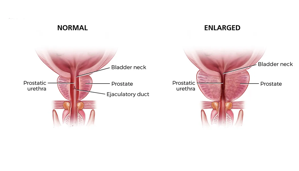 theodoros-kafasis-genikos-oikogeneiakos-iatros-kaloithis-ypertrofia-prostati
