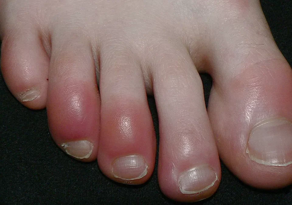 theodoros-kafasis-genikos-oikogeneiakos-iatros-xionistres-xeimetla-pernio-chilblains