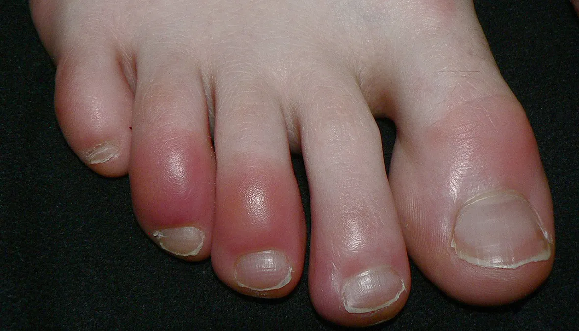 theodoros-kafasis-genikos-oikogeneiakos-iatros-xionistres-xeimetla-pernio-chilblains